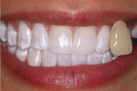 KöR teeth whitening case 1 after treatment at Signature Smiles Studio in Decatur, GA