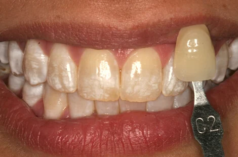 KöR teeth whitening case 1 before treatment at Signature Smiles Studio in Decatur, GA
