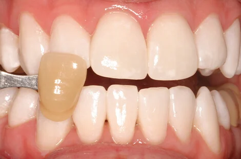 KöR teeth whitening case 2 after treatment at Signature Smiles Studio in Decatur, GA