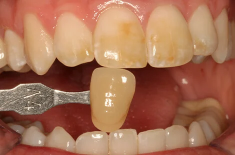 KöR teeth whitening case 2 before treatment at Signature Smiles Studio in Decatur, GA