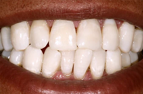 KöR teeth whitening case 3 after treatment at Signature Smiles Studio in Decatur, GA