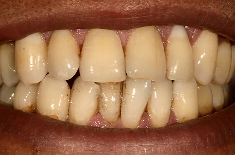 KöR teeth whitening case 3 before treatment at Signature Smiles Studio in Decatur, GA