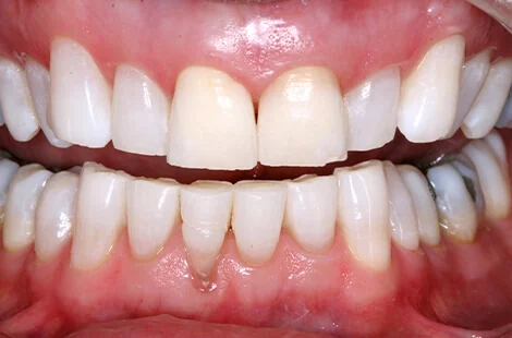 KöR teeth whitening case 4 after treatment at Signature Smiles Studio in Decatur, GA