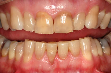 KöR teeth whitening case 4 before treatment at Signature Smiles Studio in Decatur, GA