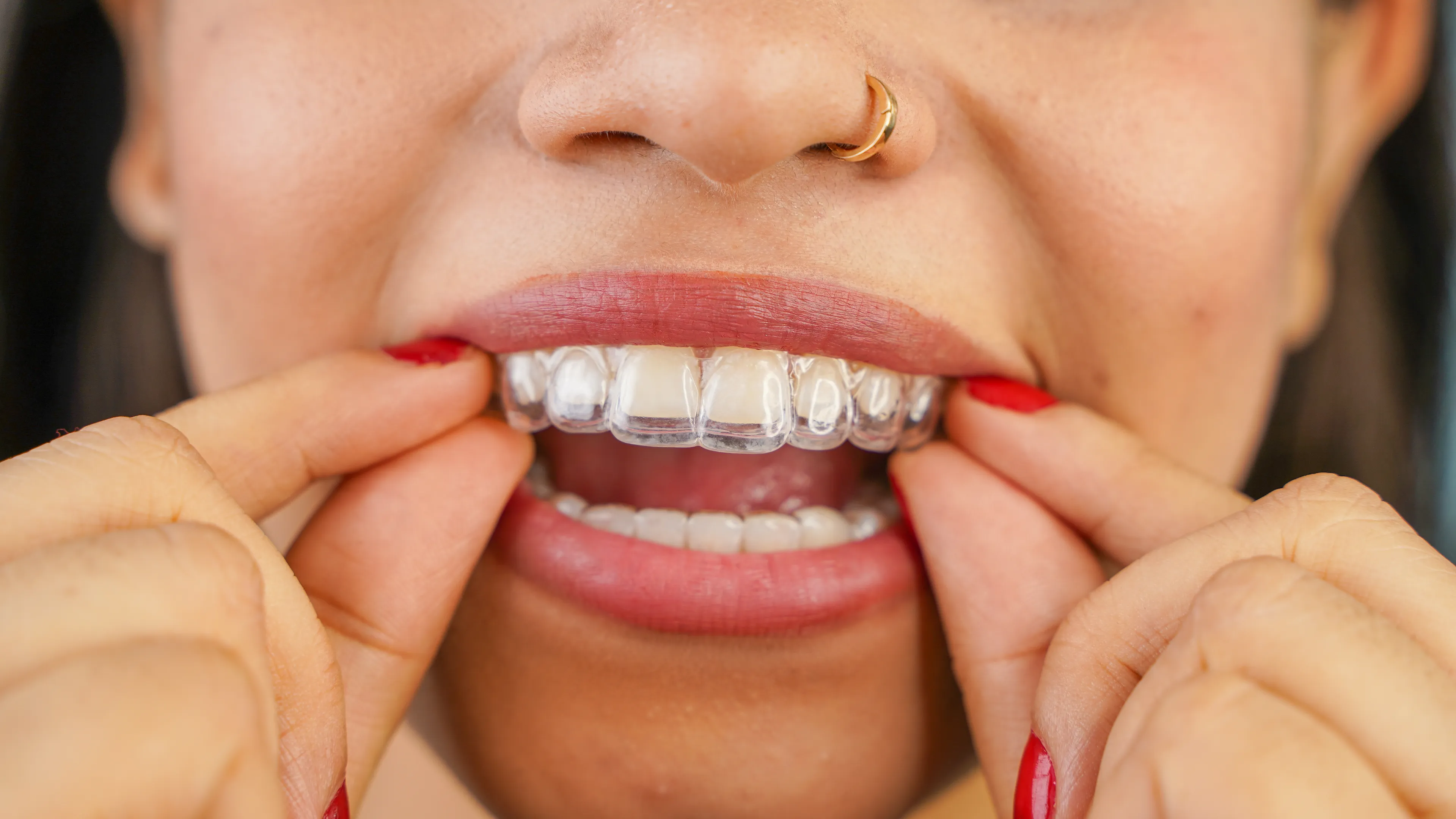 Invisalign Tips & Clear Aligner Insights