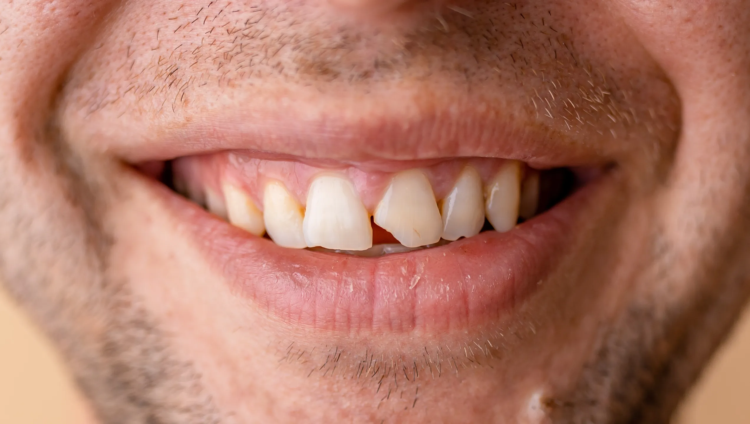 Close-up of a chipped upper front tooth, the kind of damage cosmetic bonding repairs, at Signature Smiles Studio in Decatur GA