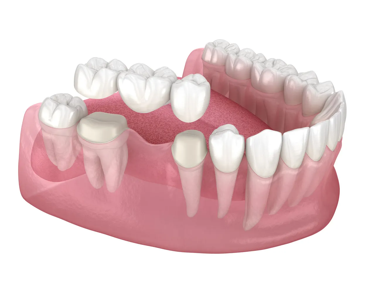 Dental Bridges in Decatur GA at Signature Smiles Studio
