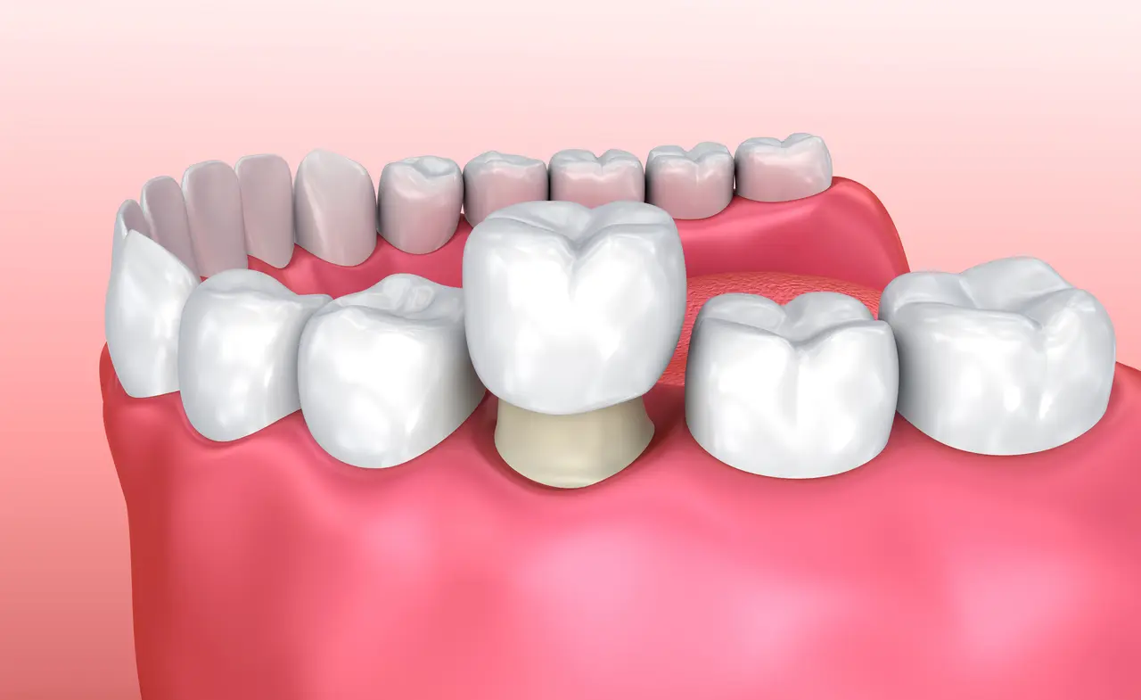 Porcelain Crowns in Decatur GA at Signature Smiles Studio