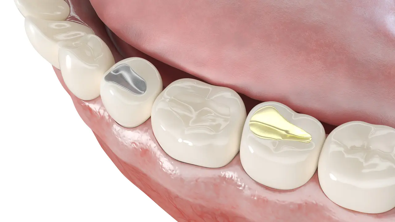 Dental Fillings in Decatur GA at Signature Smiles Studio