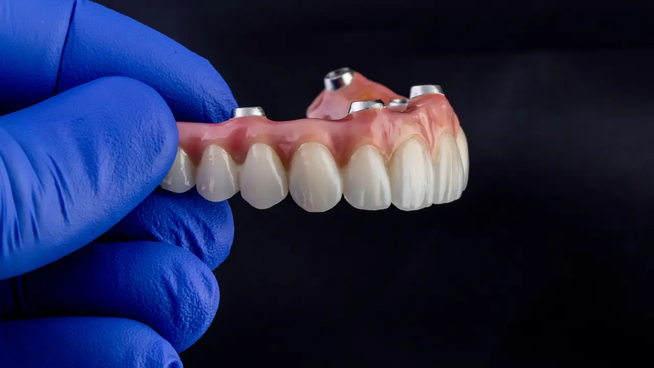 Implant Overdentures in Decatur GA at Signature Smiles Studio