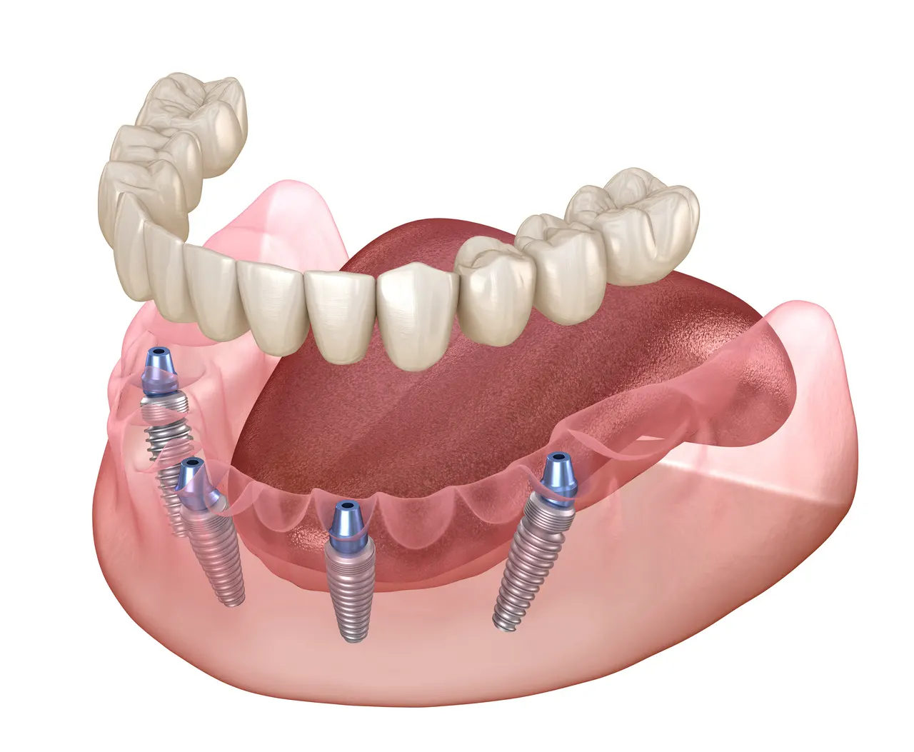 Implant-Supported Dentures in Decatur GA at Signature Smiles Studio