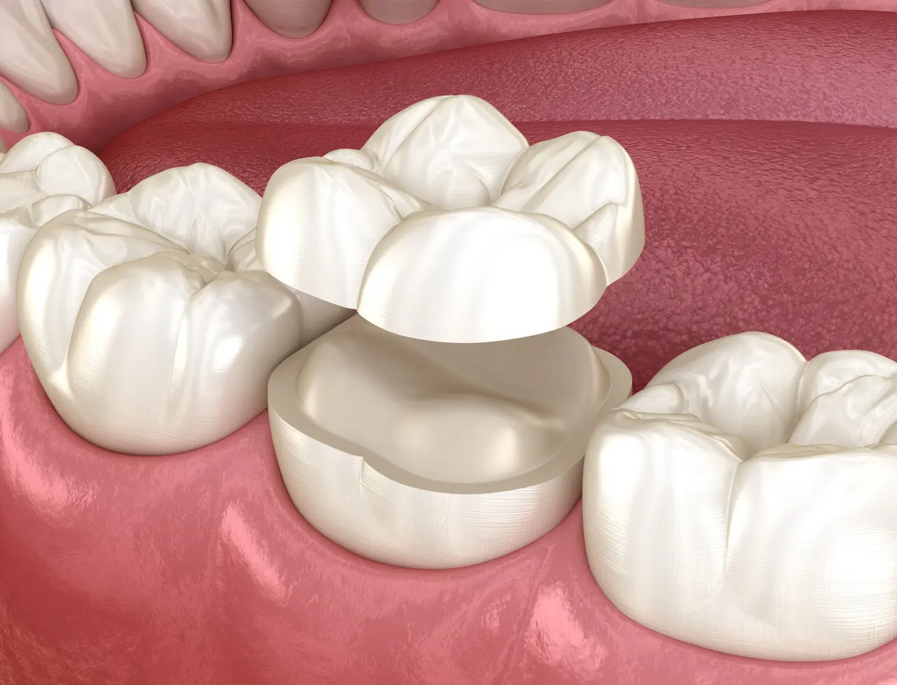 Inlays & Onlays in Decatur GA at Signature Smiles Studio