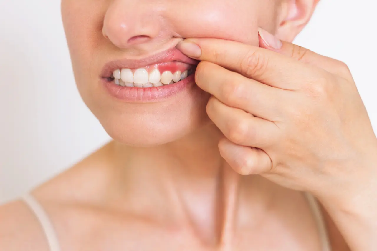 Close-up of inflamed, reddened gum tissue along the upper teeth, the condition periodontal treatment addresses, at Signature Smiles Studio in Decatur GA